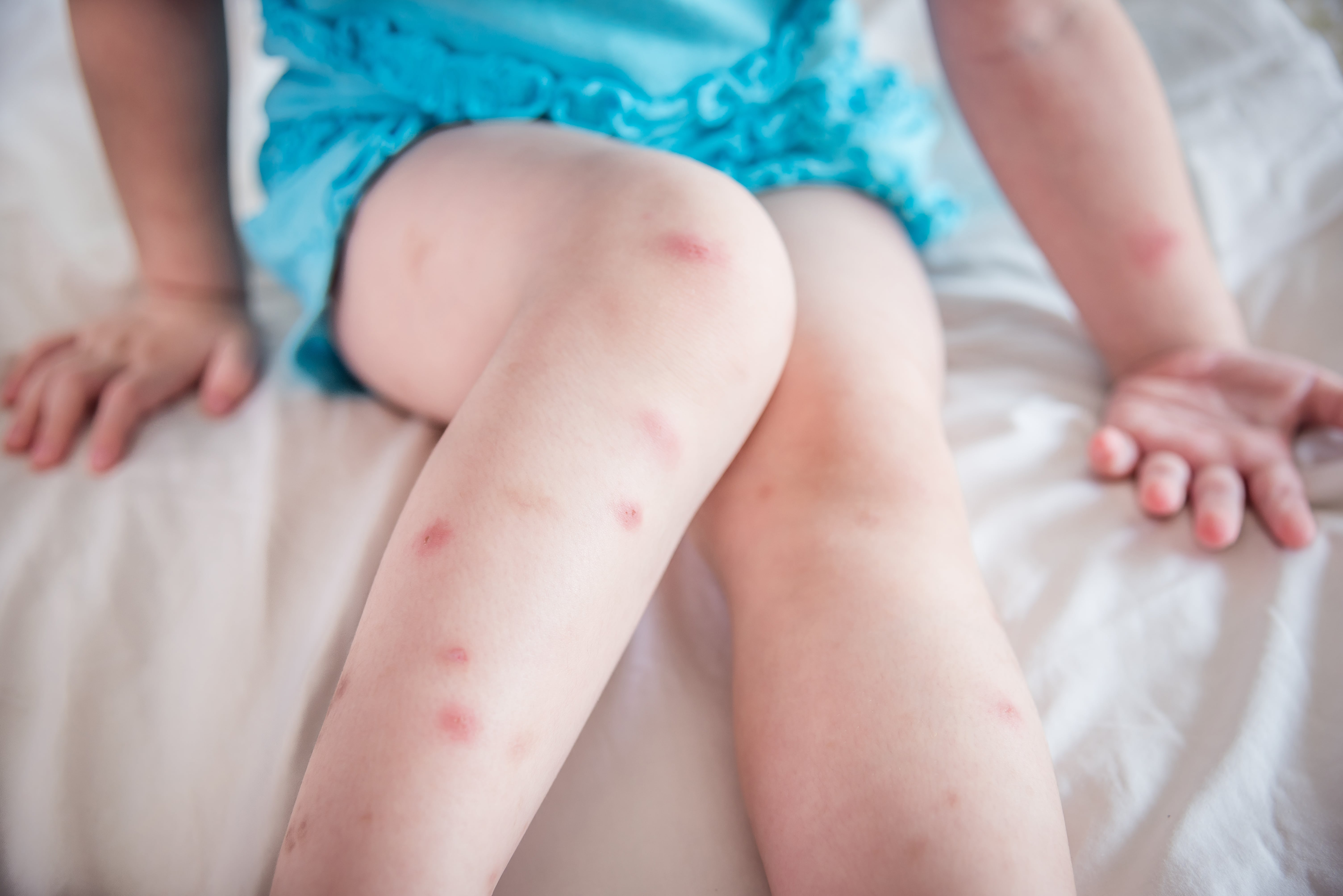 A child with several bed bug bites on their arms and legs